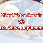 Why Mitral Valve Repair Is Better Than Replacement